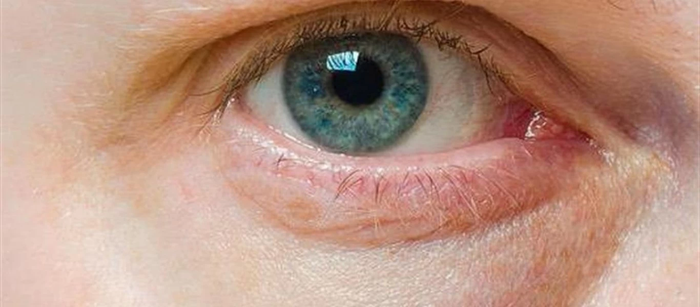 Με αυτούς τους τρόπους θα απαλλαγείτε από τις «σακούλες» κάτω από τα μάτια